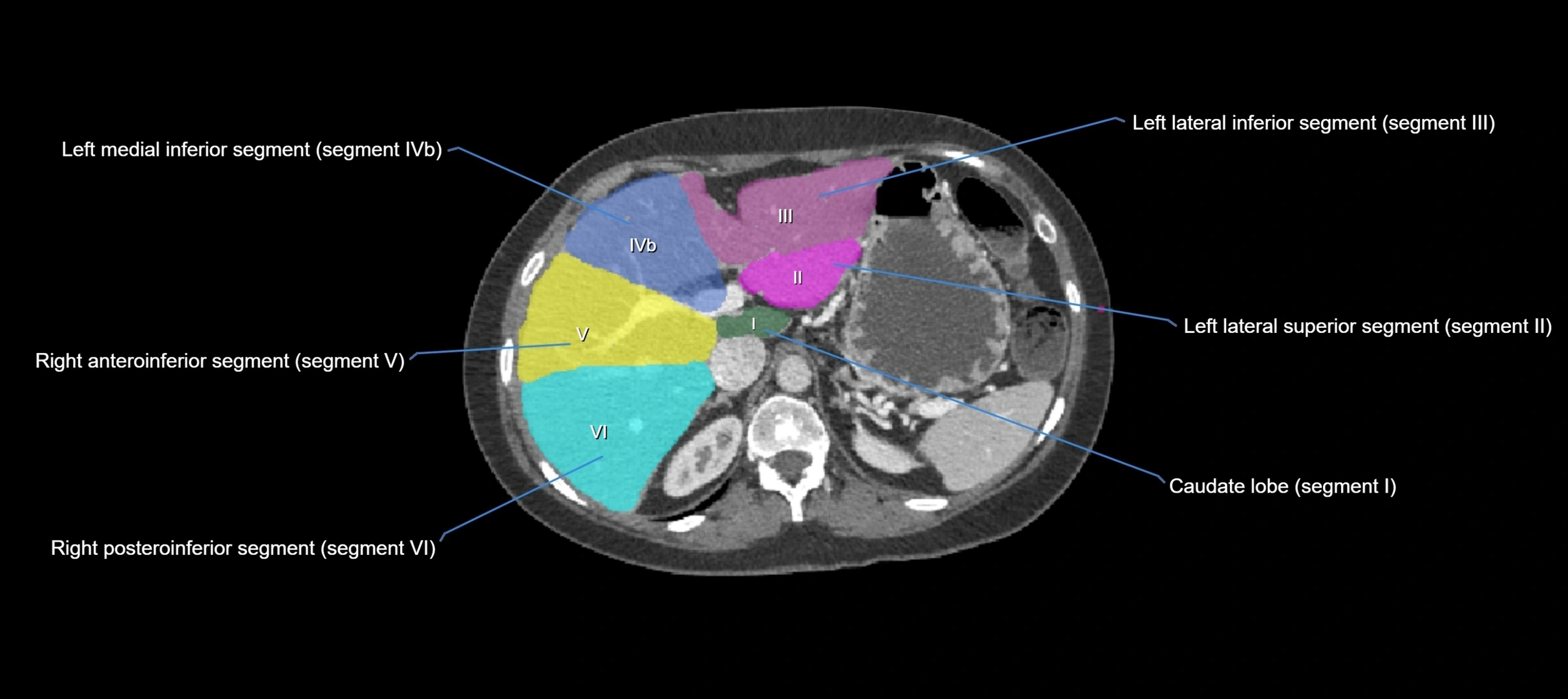 CT liver segments axial cross sectional anatomy labelled image-00048.webp